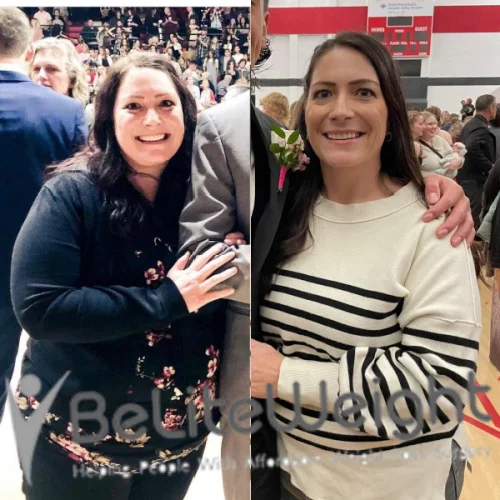 Weight Loss Surgery Gastric Sleeve before and after